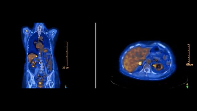 PET CT or Positron Emission Tomography  of whole human body for finding recurrent tumor. blue tone axial view pet scan. comparison coronal and axial view.  