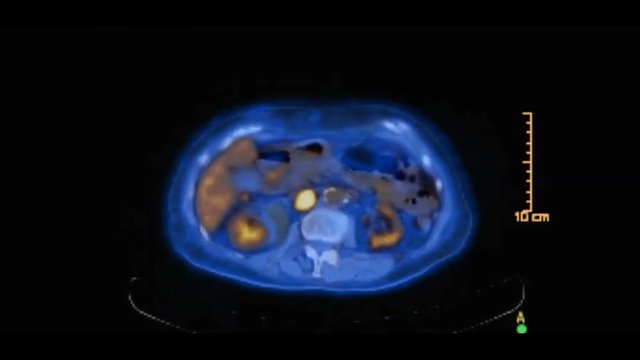 PET CT or Positron Emission Tomography  of whole human body for finding recurrent tumor. blue tone axial view pet scan.