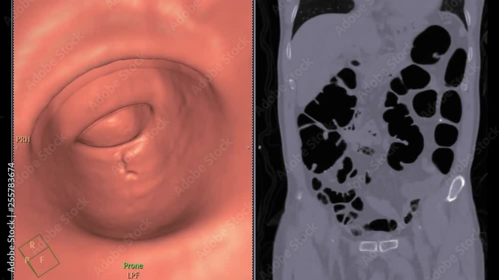 Aufkleber ct colonography or ct scan of colon comparison 3d rendering fly-through program and coronal view of 