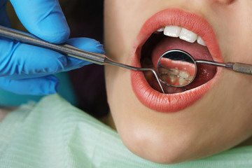 Dentist examines rear surface of woman's teeth. Young girl with open mouth. White teeth. Dentist hands with medical instruments. Close-up. Dental clinic.