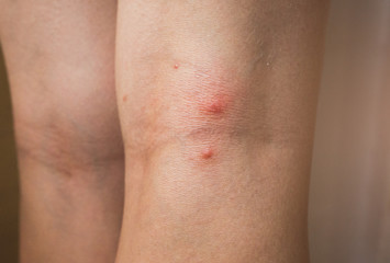 Naklejka premium Mosquito bite on woman's leg. Skin health problem. Red pimple.