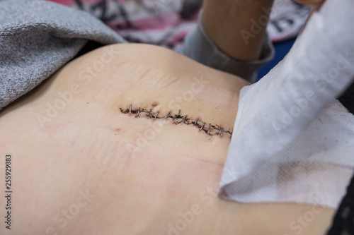 Geklammerte Wunde Nach Bauch Op Stock Photo And Royalty Free