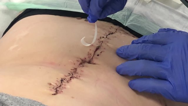 Wunde mit Steristrips verschlie&szlig;en