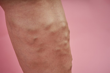 Naklejka premium Leg of senior woman with varicose veins on coral background.