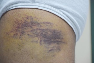 Bruises on legs after A Motorcycle Accident