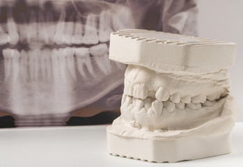 Dental casting gypsum model of human jaws with panoramic dental x-ray . Crooked teeth and distal...