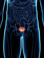 3d rendered medically accurate illustration of a diseased bladder