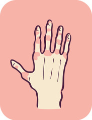 Hand Symptom Joint Redness Illustration