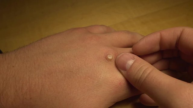 Man rubs thumb on wart on his left hand.