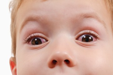 Child conjunctivitis red eye with infection,   virus. - obrazy, fototapety, plakaty