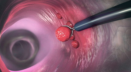 Removal of a colonic polyp with a electrical wire loop during a colonoscopy - 3d illustration - obrazy, fototapety, plakaty