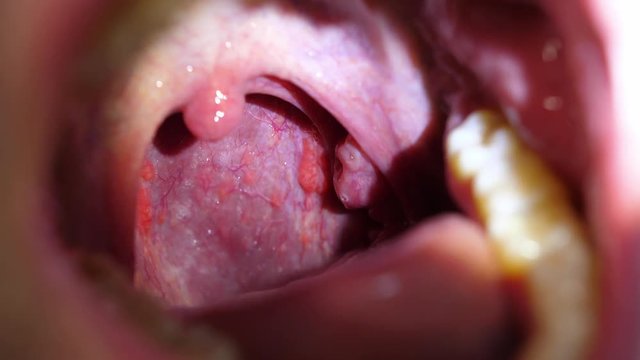 Patient With Sore Throat Examination of Strep Throat and Adenoids 