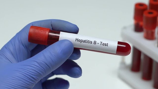 Hepatitis B-test, doctor holding blood sample in tube close-up, health check-up
