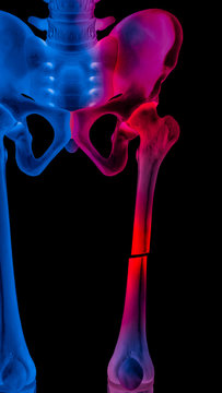 X-ray of broken upper leg or femur fracture anterior view completed displaced fracture type red highlight in right side pain- 3D Medical illustration- Human anatomy concept- Blue tone color