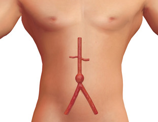 Internal view of the human body demonstrating a aortic aneurysm in the thoracic and abdominal region