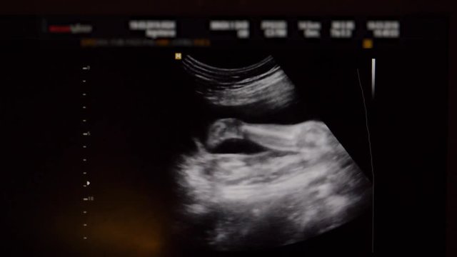 Ultrasound Of Baby In The Womb In The Second Trimester On The Monitor