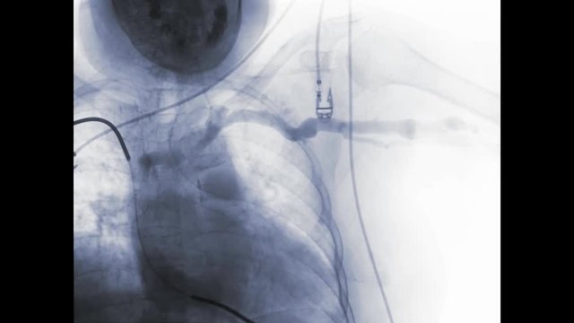Percutaneous transluminal angioplasty or PTA  of the arteries of the arm in brachial artery and cerebral ischemia