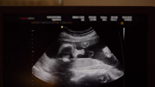 Ultrasound Of The Child In The Womb In The Second Trimester On The Monitor