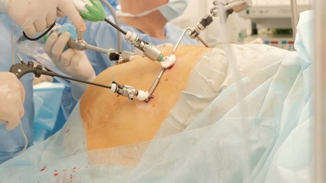 Emergency operation process. A team of surgeons performs an endoscopy to a full man or a pregnant woman. Laparoscopy - modern surgery. Camera movement