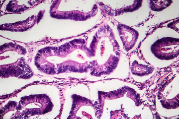 Colon cancer, light micrograph, photo under microscope