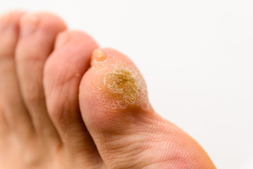 Warts on Foot and Toes