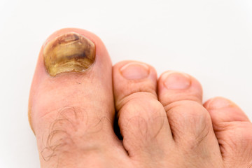 Toe Injury - Nail Falls Off