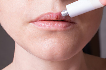 Herpes on the lips of the young woman . Woman lubricates the labial herpes ointment