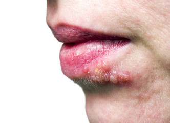 Fototapeta premium Herpes on the lip