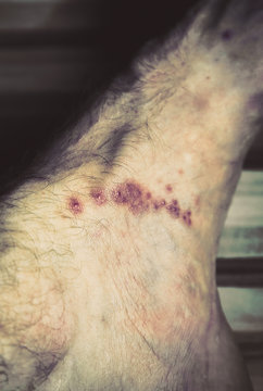 Skin diseases - scabies