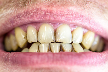 Dental plaque on yellow teeth