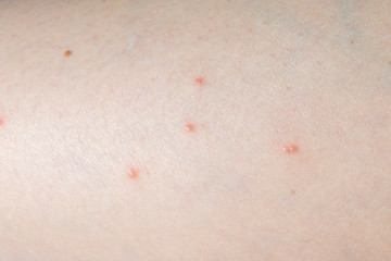 Fototapeta premium Close up of skin been bitten by ticks..Tick bites cause the skin around the bite to become red,swollen and itchy..