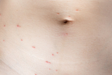 Fototapeta premium Close up of skin around navel been bitten by ticks..Tick bites cause the skin around the bite to become red,swollen and itchy..