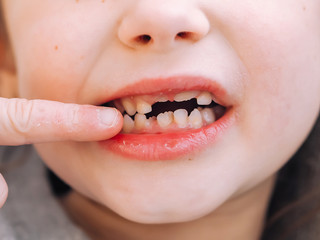 Fototapeta premium The child has a milk tooth and a new adult curve tooth. Open mouth with finger. Treatment and care milk teeth in children.
