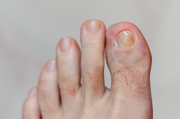Medical photo: a deformed toe and skin condition - left foot. Old injury after accident....
