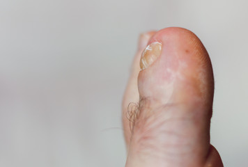 Medical photo: a deformed toe and skin condition - left foot. Old injury after accident. Lightbackground.