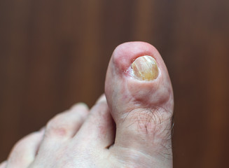 Medical photo: a deformed toe and skin condition - left foot. Old injury after accident. Dark...