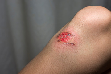 Fototapeta premium Wound on the knee of a teenager. Close up view on a scraped knee.