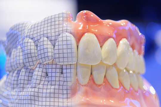 Samples of removable total prostheses of the upper and lower jaws