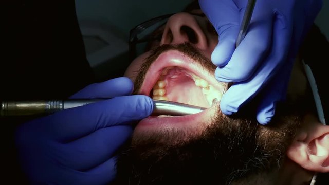 Dentist is drilling man tooth to fill a tooth. Patient in dental clinic.