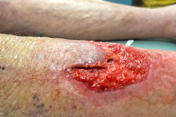 Granulating leg wound on a senior man in Tropical North Queensland, Australia - obrazy, fototapety, plakaty
