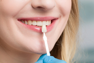Using shade guide at womans mouth to check veneer of tooth crown