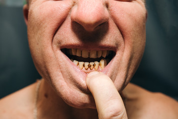 Plaque teeth cavities and paradontosis in the man's mouth. Dental decay problems and bad smile. Dentist treatment concept.