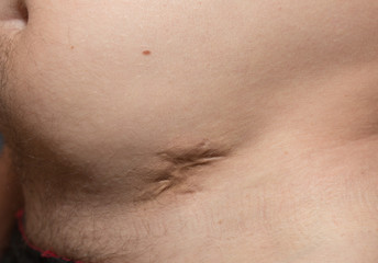 Ugly bad scar on the man's fat belly after the appendicitis surgery. Old keloid scar on the stomach. Medical treatment disease photo.
