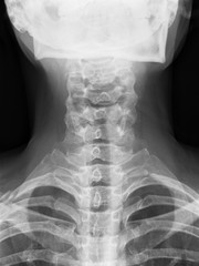 X-ray picture - Cervical spine