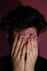 an acne on man's forehead