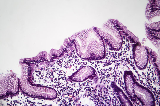 Histopathology of chronic superficial gastritis, light micrograph, photo under microscope