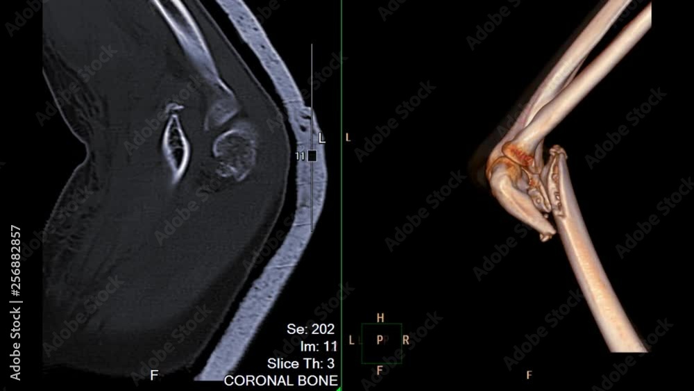 Poster ct elbow comparison sagittal plane vs 3d rendering image showing fracture of distal humerus bone.