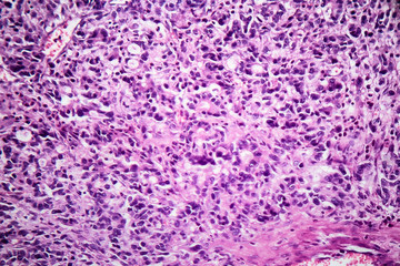 Gastric adenocarcinoma, light micrograph, photo under microscope