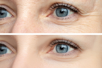Woman face, eye wrinkles before and after treatment - the result of rejuvenating cosmetological...