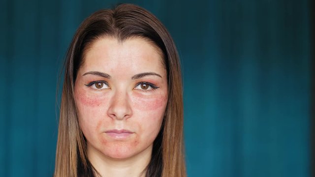 The girl with hematomas on a face. Fractional laser. Consequences of the cosmetology procedure.